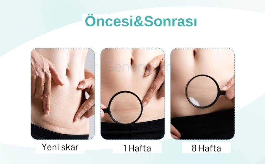 REF GENERATİON Silikon Jel Şerit (30 cm) - 5